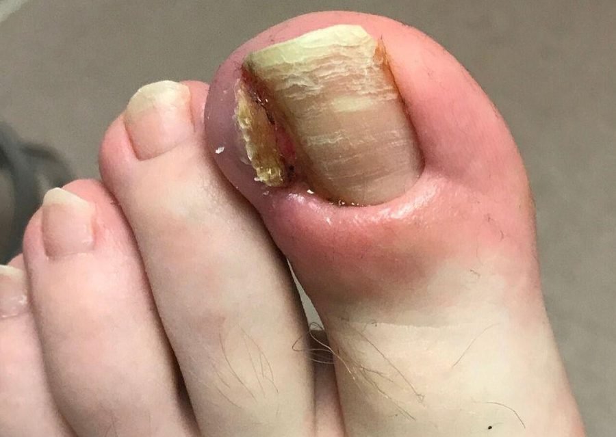 A podiatrist treating an ingrown toenail on a big toe